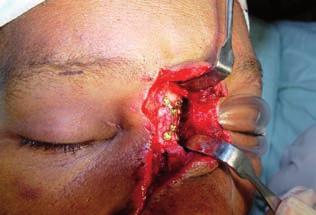 Nasal bone Os nasale Clinical case 2 Gender, Age: Female patient, 49 years Incident: Suffered a facial trauma