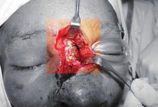 access, the reduction of the naso-orbital-ethmoid fracture could be fixed, with repositioning the extraoculare
