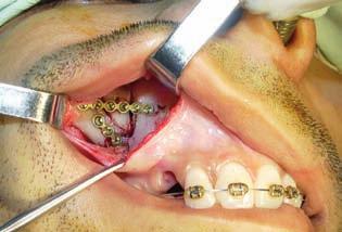 a motorcycle rider Diagnosis: fracture of upper jaw Treatment: