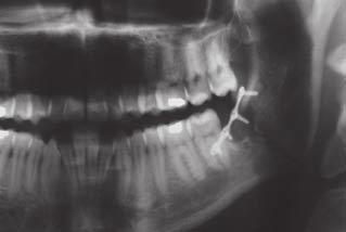 approach, reduction of the jaw fracture could be