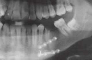 fracture Treatment: By intraoral approach, a jaw