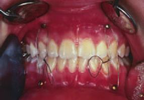 retrognathism of the upper maxilla and angle class III interlocking tooth position 1/2 pb