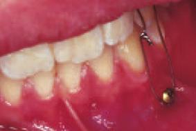 Due to a largely already harmonized position of the teeth rows there was no need for