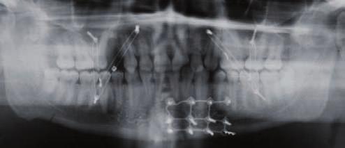 IMF Inter-Maxillary-Fixation Clinical case 14 Gender, Age: Male patient, 17 vears Diagnosis: triple mandible fracture (collum both sides and front left).