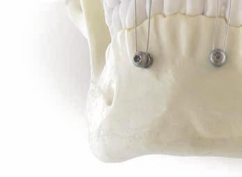 Implants Screws IMF Quick Fix Description Oral Maxillofacial procedures often require an intermaxillary fixation in order to create a safe and reliable occlusion.