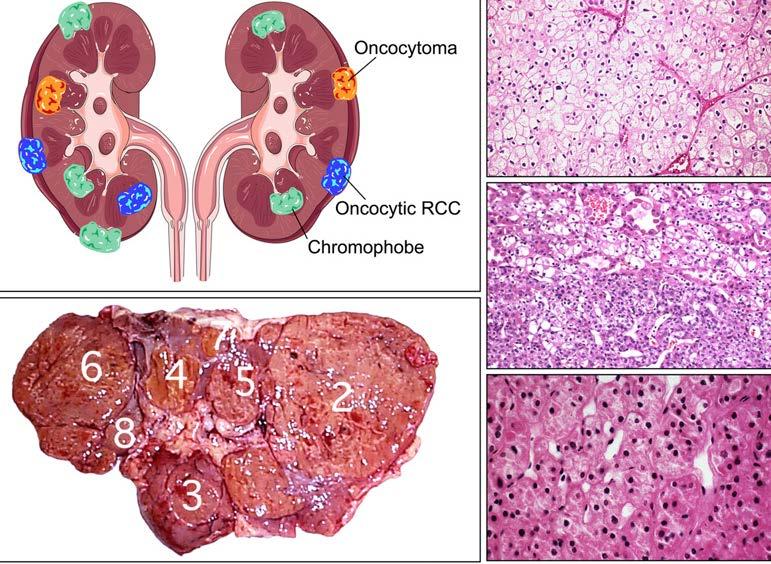Chromophobe kidney cancer.