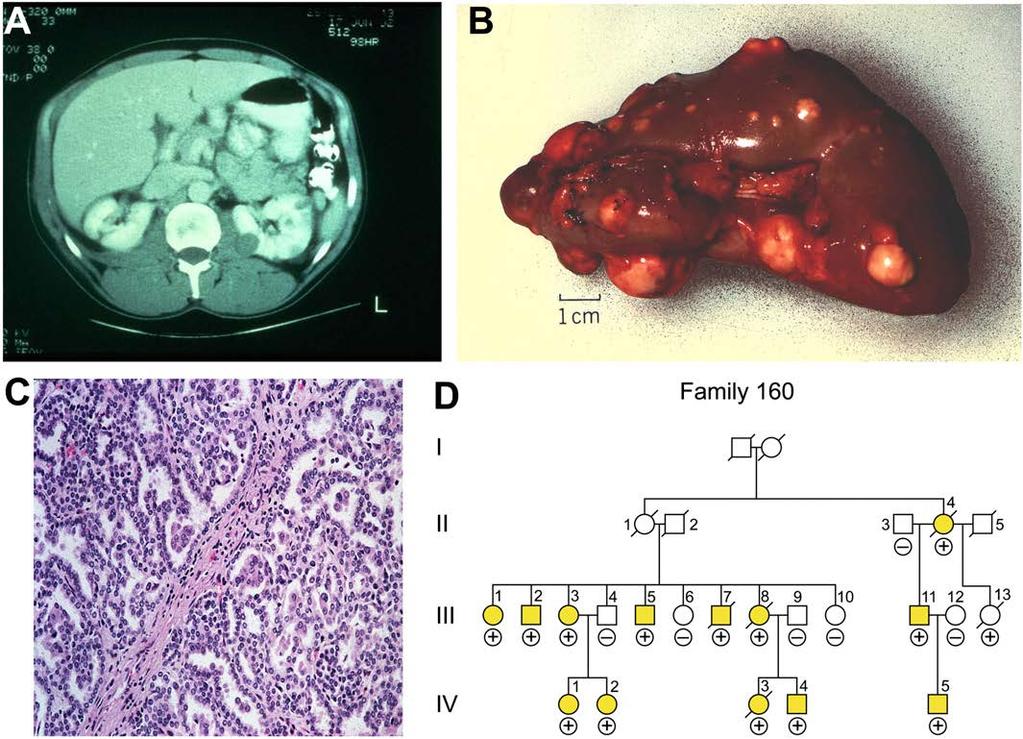 Type 1 papillary kidney cancer.