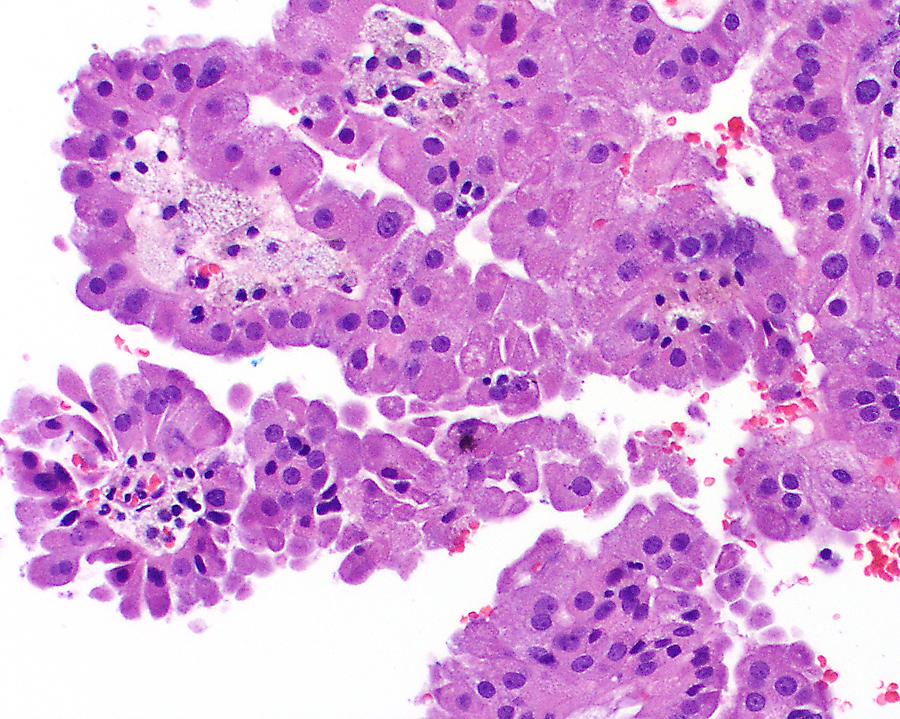 Papillary Type 2 RCC Made up of a number of different non type-1 papillary RCCs Hereditary Leiomyomatosis (HLRCC): germline mutation of the fumarate hydratase