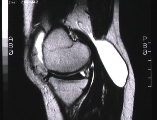 Baker s Cyst and the Meniscus Stone, et al (1996) Case-control study Over 1700 MRI s 240