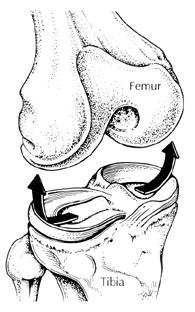 Discoid Meniscus Programmed cell death More likely to tear Often Lateral Male >