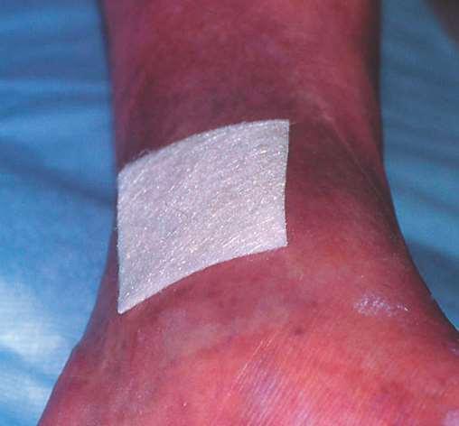 Alginates [Advantages] Highly absorbent Hemostatic, do not adhere to wounds Fewer
