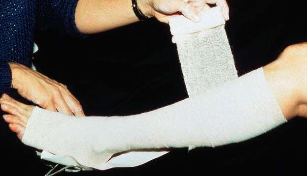 Venous ulcers Compression bandages Unna boot semirigid paste bandage, applied