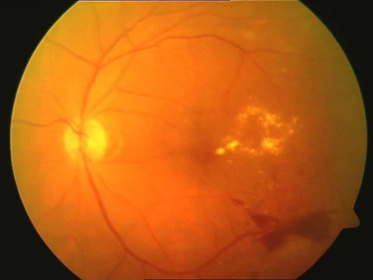 Exudates, Macula Edema and Hemorrhages indicate levels of Diabetic Retinopathy that is taken into consideration for the detection of level of this disease [9].