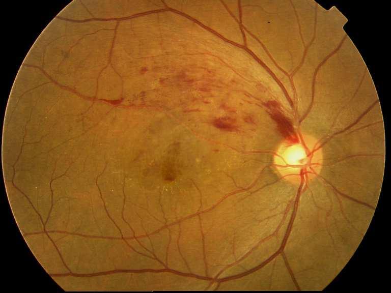 The colour fundus image of a normal patient (not affected by Diabetic Retinopathy) is as shown in figure (1).