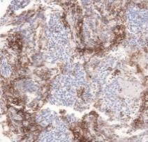Staining PD-L1 Positive: Tumor Staining PD-L1