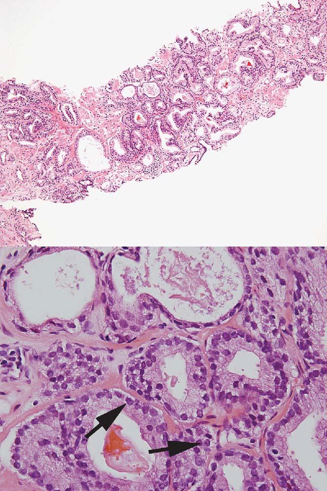 Rare foci of atypical glands suspicious for carcinoma were present in DAPZ cases. These foci showed slightly hyperchromatic nuclei with prominent nucleoli (arrows).