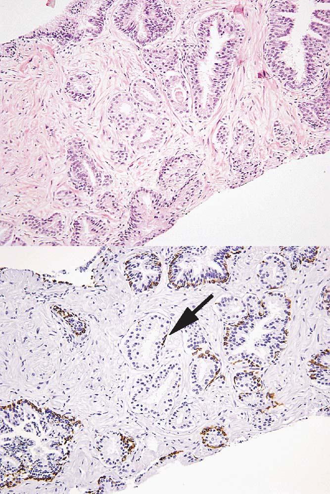 Am J Surg Pathol Volume 32, Number 9, September 2008 Diffuse Adenosis of the Prostatic Peripheral Zone FIGURE 5.