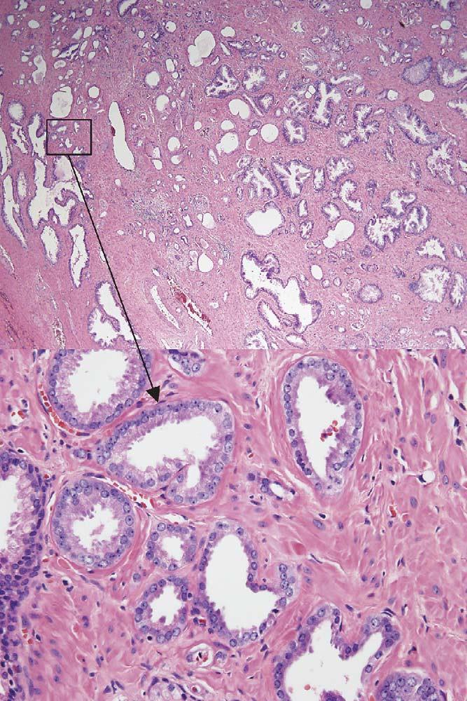 Radical prostatectomy specimen from patient with DAPZ showed varying numbers of nonlobular and crowded small acinar foci interspersed throughout normal prostatic glands in the peripheral zone.