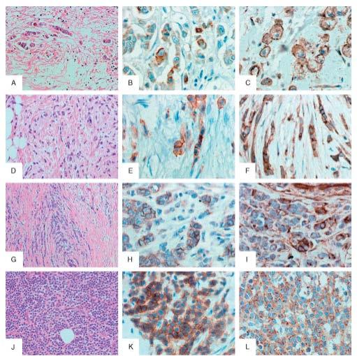INCORRECT INTERPRETATIONS AND CONCLUSIONS Aberrant E-cadherin expression in lobular breast