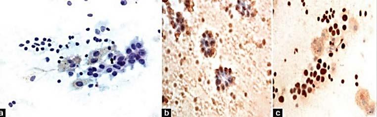 EFFECT OF THE LOCAL ENVIRONMENT METASTATIC TUMORS 73-year-old woman with a 4 cm thyroid mass and compressive symptoms Lesions in brain, lung, adrenal and lymph nodes Thyroid FNA +