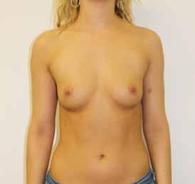 AFTER breast augmentation by Dr Miroshnik