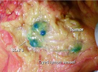 Fig. 9. Average numbers of lymph nodes and sentinel lymph nodes in the resecred spicimen. Lymph nodes Localisation Colon cancer Rectal cancer Lymph nodes (n) 15,2 13,6 Sentinel LN (n) 1,9 1,6 Fig. 10.
