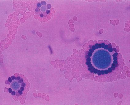 Figure 2. Mycoplasma genitalium colonies (dark blue) in culture. Photo provided by Jørgen Skov Jensen, Statens Serum Institut The first PCR assays for detection of M.