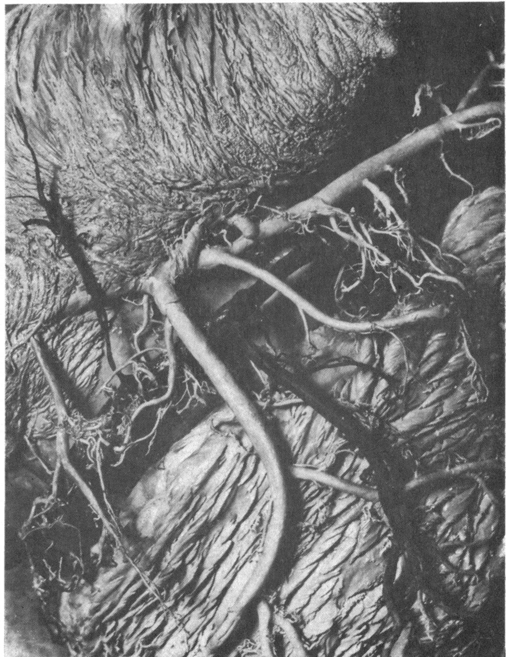 108 William B. Hood Oblique Vein Left Atrium Coronary Sinus Posterior Vein of.----- the tight Ventricle FIG. 3.
