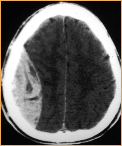 Meningeal Vasculature & Nerves Blood between the skull and dura has no route for clearance. Pressure builds on the brain. 20% of epidural hematomas are lethal.