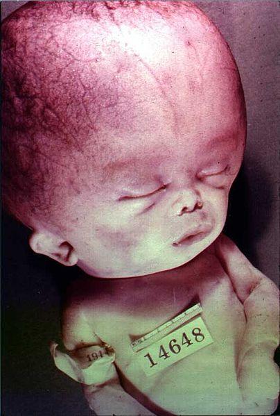 Hydrocephalus Obstruction in the ventricular system can block the flow of CSF and result in increased pressure in the