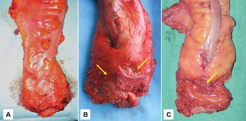 Gross pathology - TME assessment Macroscopic Assessment of Mesorectal Excision in Rectal CancerA