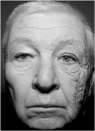 PHOTOAGING Unilateral Dermatoheliosis Truck driver for 28 years Chronic UVA exposure through