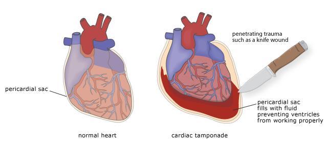 Signs and symptoms can include chest pain, respiratory distress, cardiac dysrhythmias, chest wall bruising and tenderness.