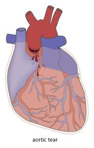 Aortic Tear An aortic tear occurs when a person s body experiences rapid deceleration. The aortic root and arch shear where they are attached to the heart. Most of these victims die immediately.
