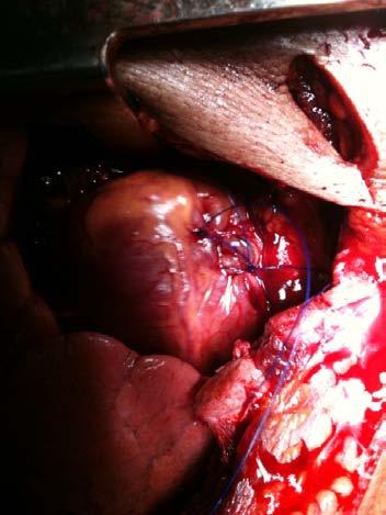 Operative Procedure Pericardiotomy partial closure 32F chest tube placed