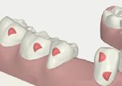 Deep Bite s are used for anchorage/retention or activated for premolar Upper and lower premolars Pressure Areas Anterior intrusion Incisors and lower canines Precision Bite Ramps (are not SmartForce