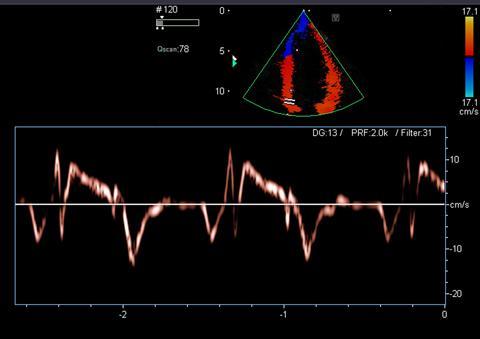 Tissue Doppler Imaging S E (cm/s) S (cm/s) E/E E Tissue Doppler imaging measured peak early