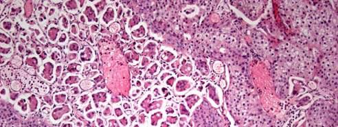 disease, lymphovascular invasion frequent; high rate of LN metastasis Any amount of micropapillary differentiation may be considered significant ; Prognosis worsens with increase of this component