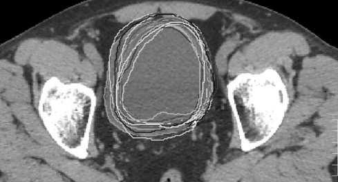 Transverse, sagittal and coronal CT simulation images of