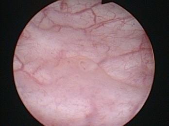 Prostatic urethra biopsy retur in 2-6