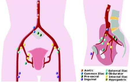 N staging N1-N2 = Regional lymph nodes = true pelvis perivesical hypogastric,