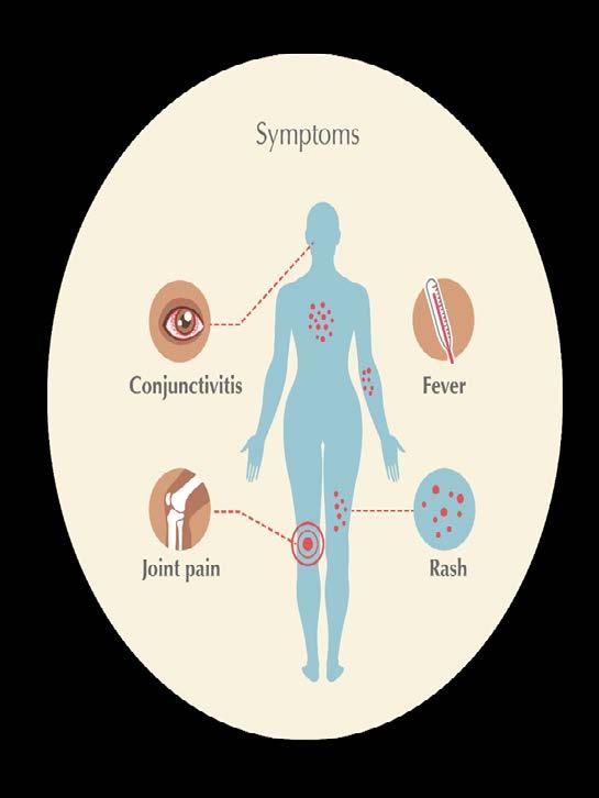 ZIKA VIRUS: SYMPTOMS OF INFECTION Most people infected with Zika virus do not experience any symptoms About