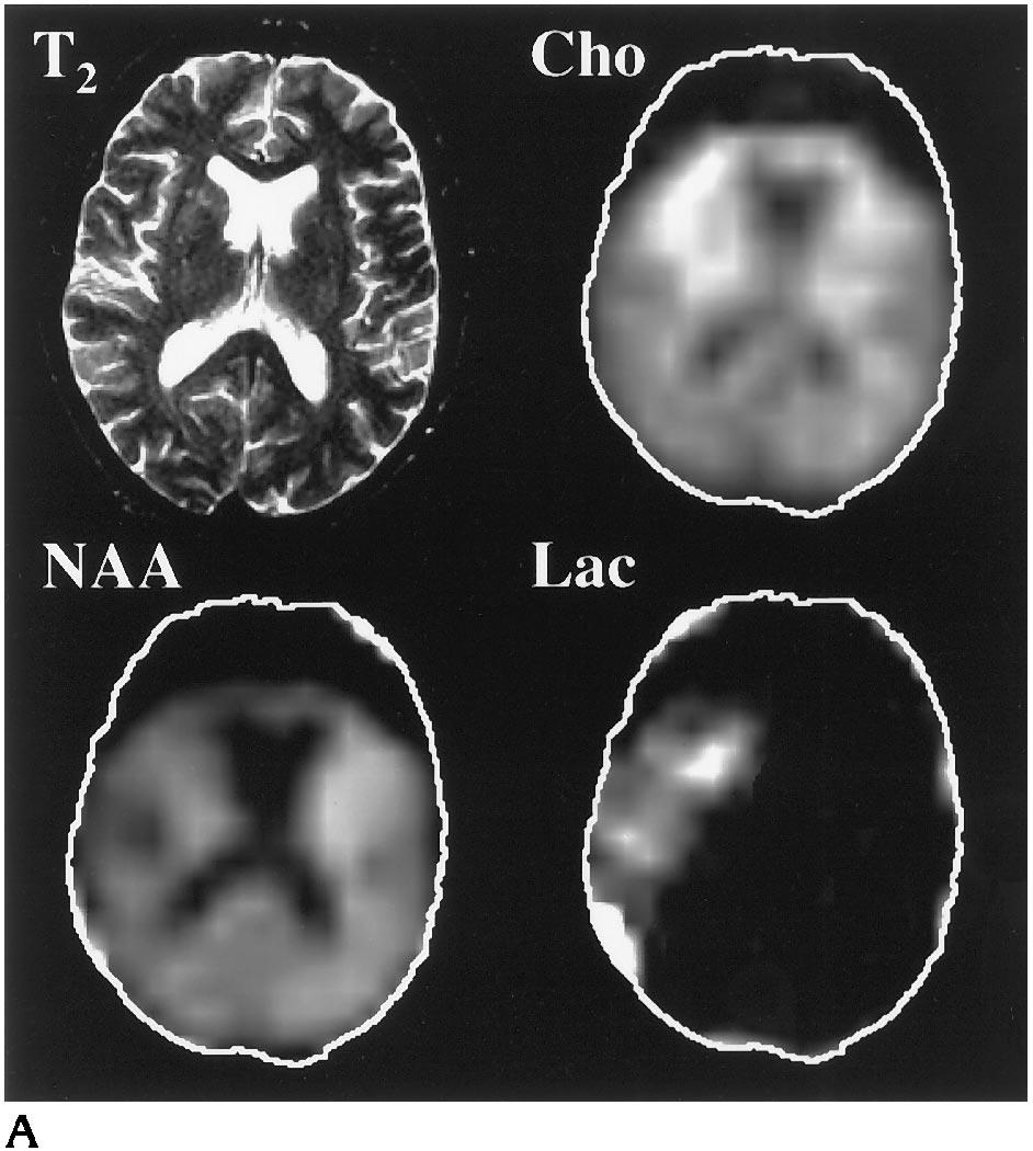 AJNR: 17, May 1996 MR SPECTROSCOPY IN STROKE 879 Fig 3. Patient 4: right internal carotid artery occlusion and low flow in right middle cerebral artery were seen at MR angiography.
