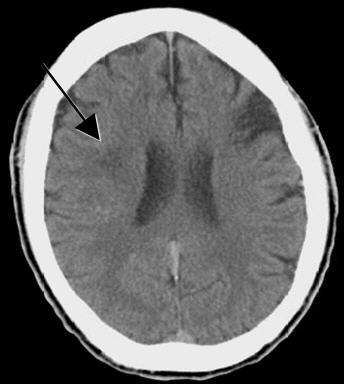 ABBREVIATIONS HTN- Hypertension DM- Diabetes Mellitus CVA- Cerebro-vascular accident MRA- Magnetic Resonance Angiography CT- Computed Tomography MRI- Magnetic Resonance Imaging MCA- Middle Cerebral