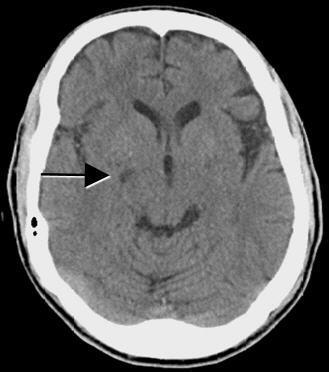 Figure 3: Axial CT scan of brain without contrast.