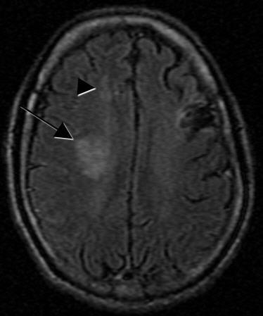 of probable lacunar infarct in the right frontal lobe (arrowhead).