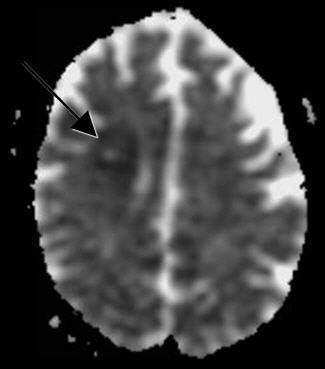 Figure 9: Brain MRI without contrast (axial T2 weighted