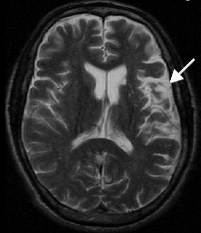 Figure 8: Brain MRI without contrast (ADC map): Showing infarct