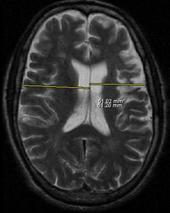 Figure 10: Brain MRI without contrast (axial T2 weighted
