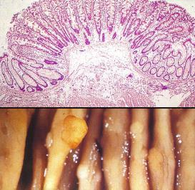 ring >10% of all colon ca are mucinous (>50% mucin production) <1% of all colon ca are signet ring cell (>50% signet rings) 43 Polyps